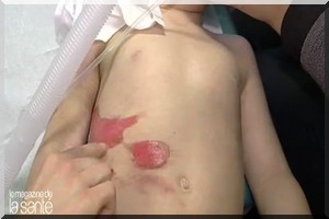 Deux écoliers soumis à la torture par le feu dans un établissement privé