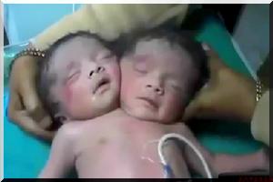 Naissance D Un Bebe A Deux Tetes En Inde Video