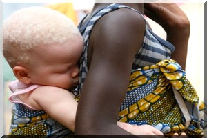 La discrimination des albinos : Un phénomène sous silence en Mauritanie