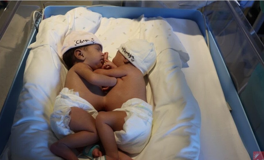 Barcelone : une opération réussie pour séparer deux enfants mauritaniens siamois